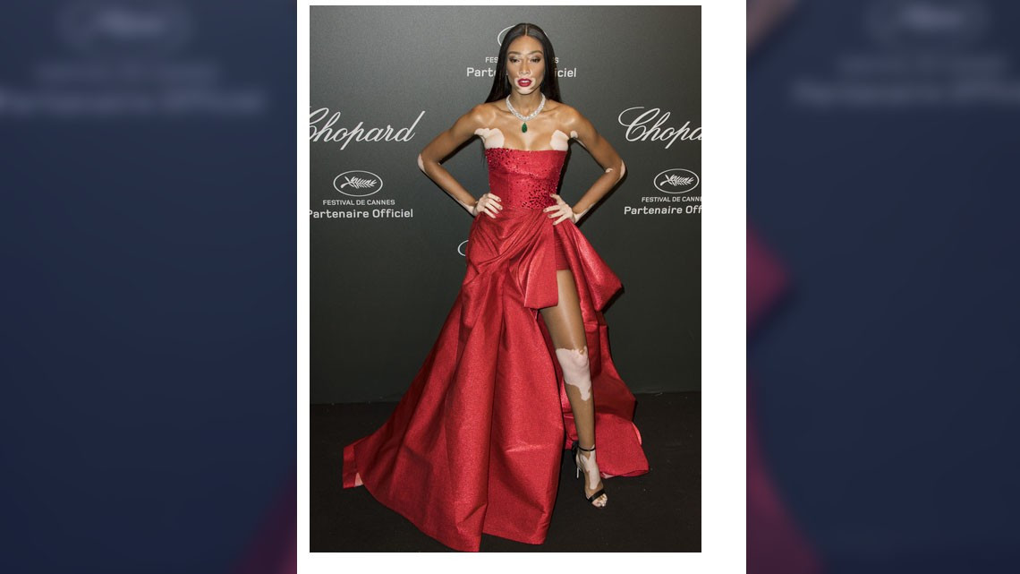 Winnie Harlow es elegida para desfilar en Victoria's Secret