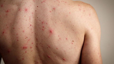 México registra 24 muertes y más de 5 mil 700 casos de sarampión, alerta Salud