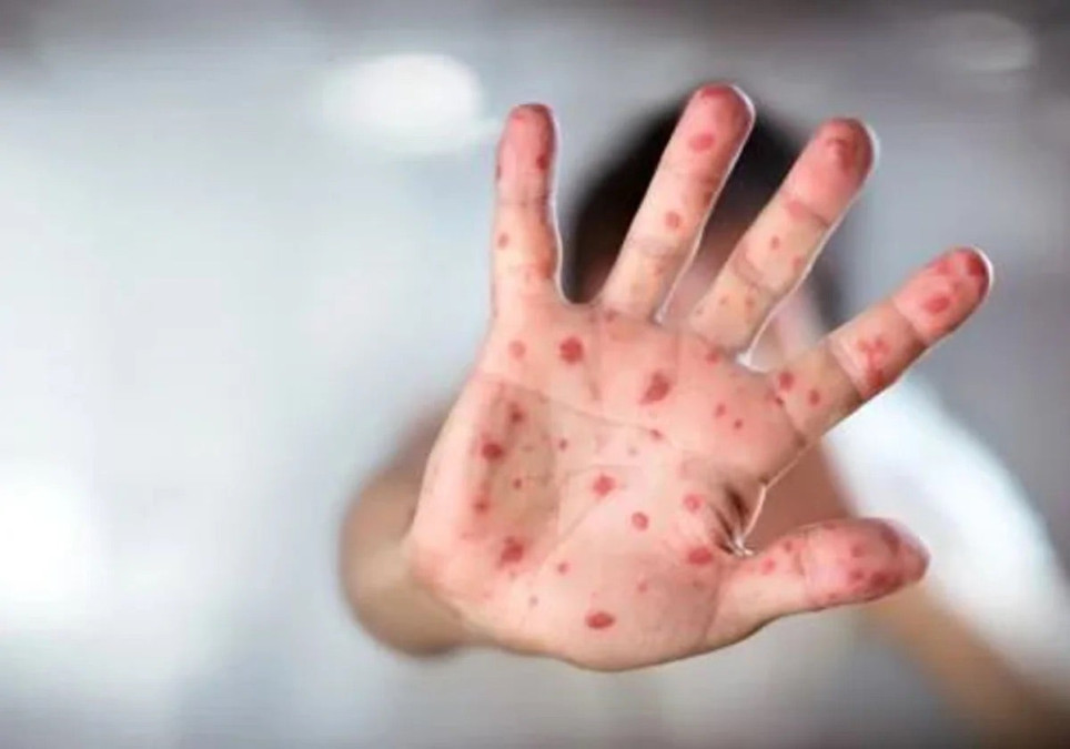 Salud reporta 43 casos de sarampión en el país